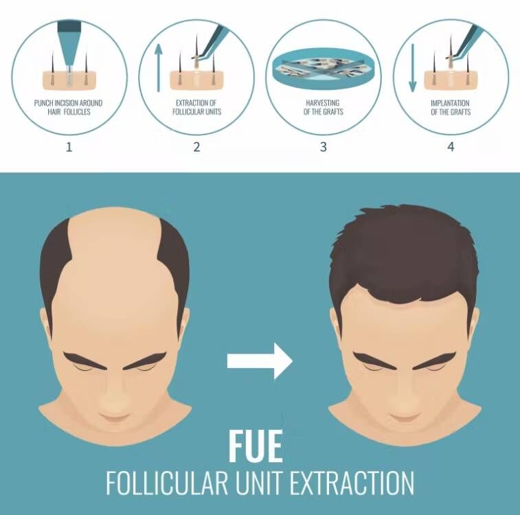 FUE-máquina de Trasplante de C - Hair Care Vegan reseña y precio
